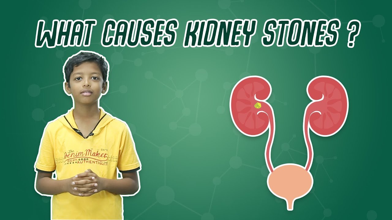 What Causes Kidney Stones ?